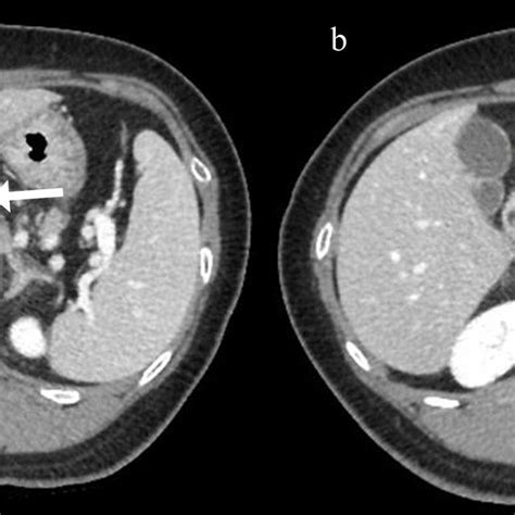 Abdominal Computed Tomography Ct Scan At The Time Of Emergency