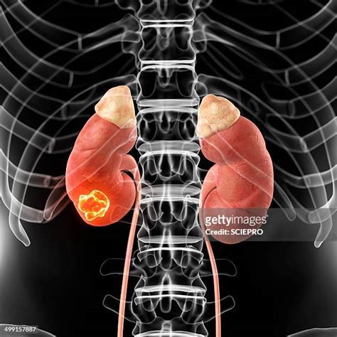 Adrenal Gland Tumor Photos And Premium High Res Pictures Getty Images