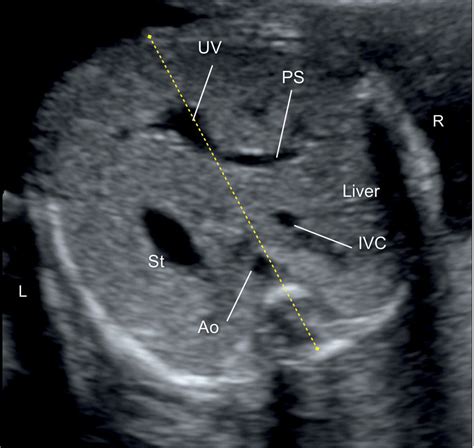 Transverse Sections Of The Fetal Abdomen Showing A Fetal Stomach S Hot Sex Picture