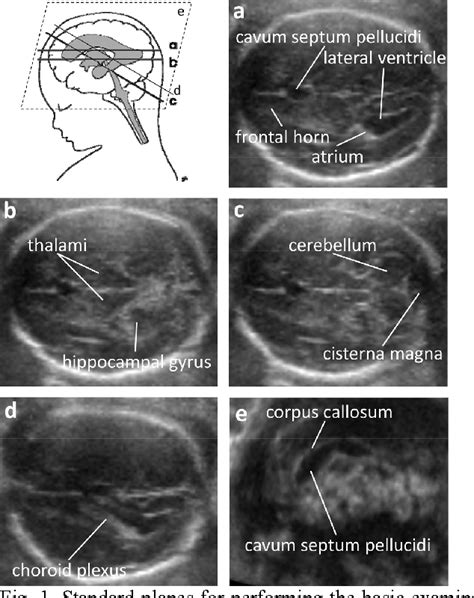 Figure 2 From Automatic Measurement Of Fetal Head Structures Using Ultrasound Semantic Scholar