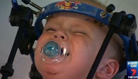 Surgeons Reattach Toddlers Head After Car Accident Dailypedia