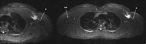 It acts on the shoulder and scapula, with its biggest role the muscle consists of two heads: Pectoralis major tear in a 23-year-old woman while performing high-intensity interval training ...