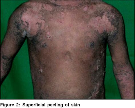Epidermolytic Hyperkeratosis With Rickets Indian Journal Of