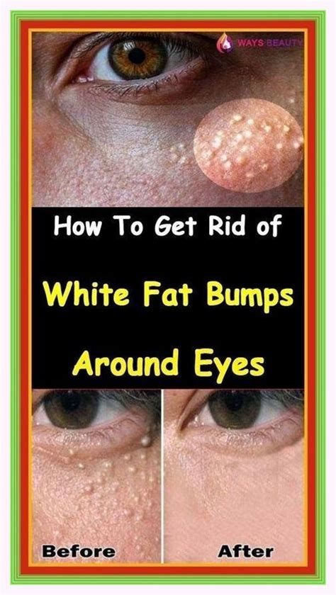 How To Get Rid Of White Fat Bumps Around Eyes Naturally Artofit