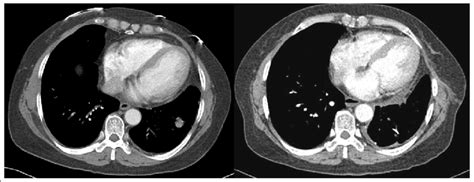 On Chest Ct Scan 18 Cm Sized Solitary Pulmonary Nodule Was Noted In