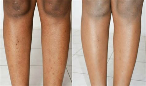 The causes of this disease are unknown; 8 Ways to Get Rid Of Dark Spots on Legs Fast | HowHunter