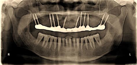 Dental Implantsfixed Teeth For Every One Dental Implant Speciality