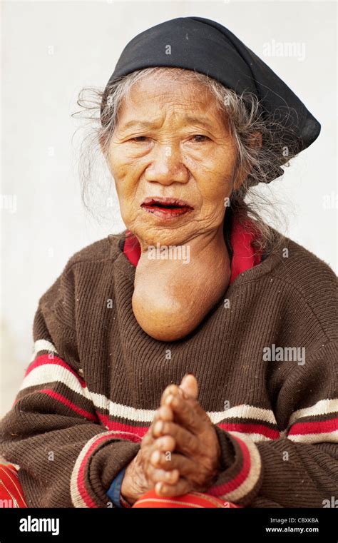 Goiter Hi Res Stock Photography And Images Alamy