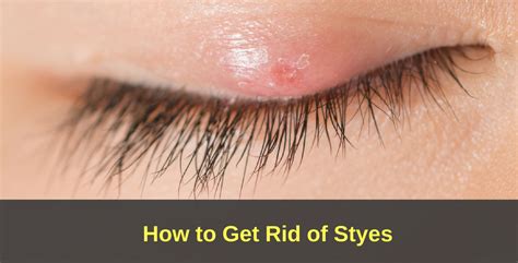 How To Get Rid Of A Stye Are Styes Contagious Symptoms And More