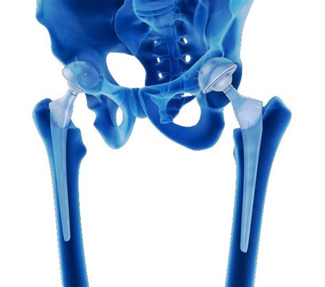 Learn About The Newest Hip Replacement Procedure All Pro Orthopedics