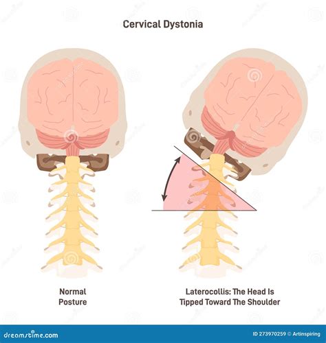 Cervical Dystonia Spasmodic Torticollis Inflamatory Condition When Neck Stock Vector