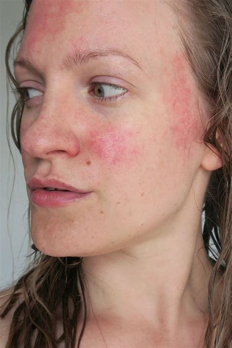 Red Spots On Your Skin