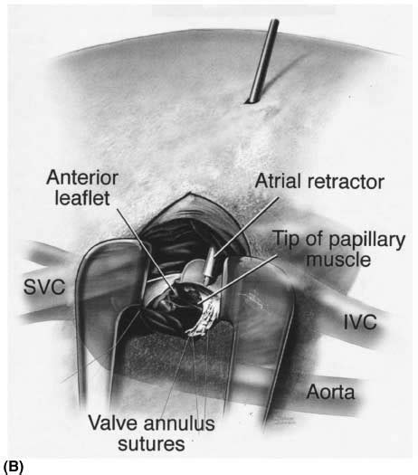 Operative Exposure Of The Mitral Apparatus Via A Right Lateral Mini