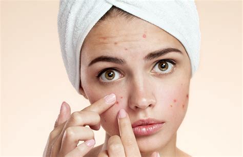 Benzoyl Peroxide For Acne Mypointis