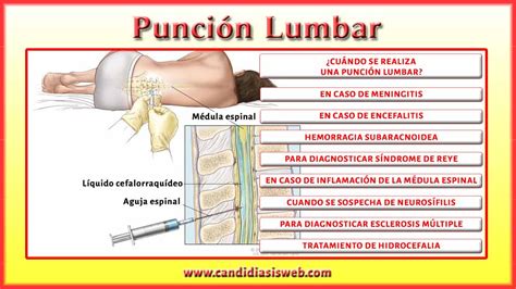 La esclerosis múltiple es la primera causa de discapacidad sobrevenida en adultos jóvenes, ya que suele afectar a personas de entre 20 y 45 años. Pruebas y Examenes - Punción lumbar