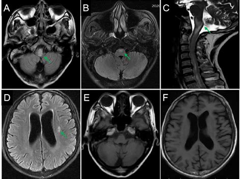 Brain Magnetic Resonance Imaging T2 Weighted Imaging Wi Showing