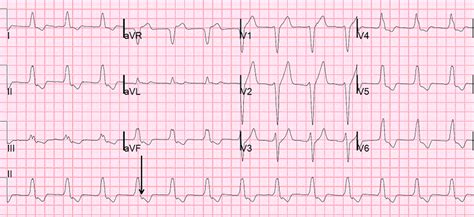 Dr Smiths Ecg Blog What Is The Rhythm And Is There New Left Bundle