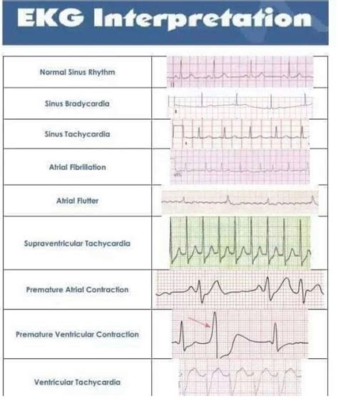 √ How To Read Ecg