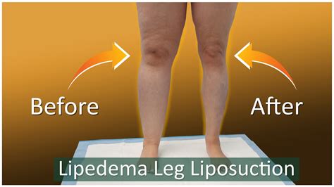 Liposuction Results Cankles And Knees Lipo 360° Legs Lipedema