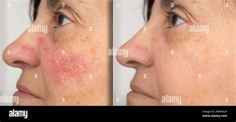 A Close Up Portrait Of Before And After A Mature Woman Showing Redness