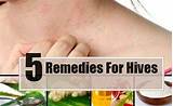 Urticaria And Angioedema Home Remedies Images