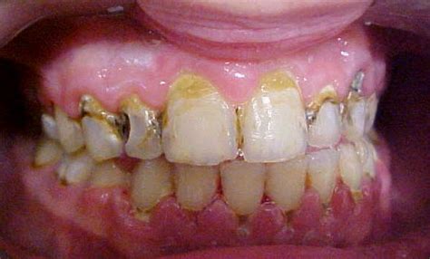 White Spot Lesions Creating Beautiful Smiles