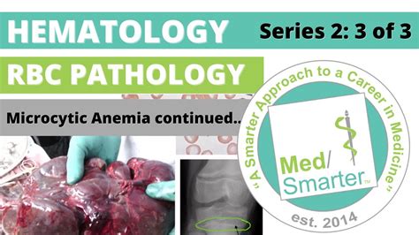 Usmle Step 1 Hematology Microcytic Anemia Medsmarter Part 3 Of 3