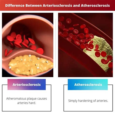 Arteriosclerosis Vs Atherosclerosis Difference And Comparison