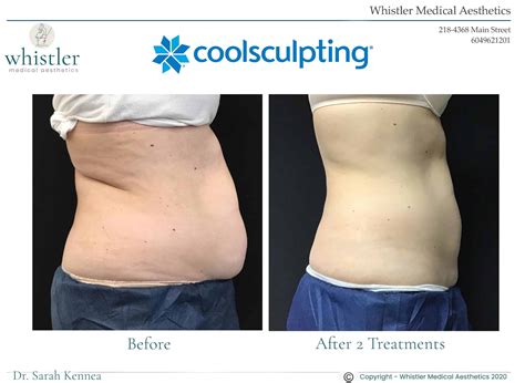 Does Coolsculpting Work Whistler Medical Aesthetics
