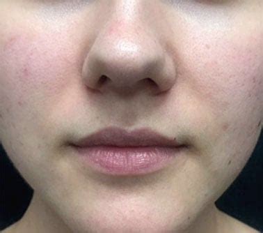 We use the most advanced micro channeling technology to. Microneedling Treatment - Dermatology Pittsburgh