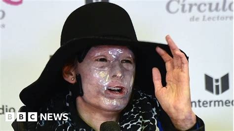 Colombia Introduces Harsher Sentences For Acid Attacks Bbc News