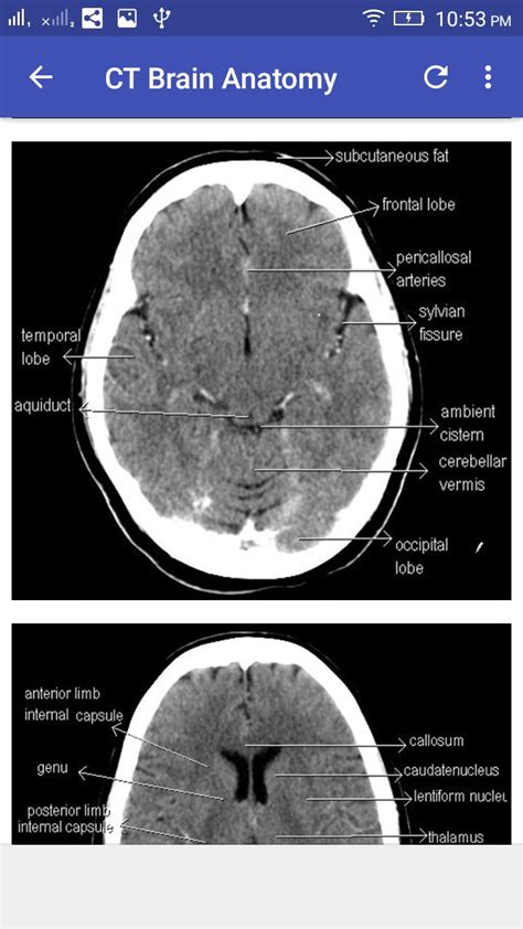Ct Scan Brain Anatomy