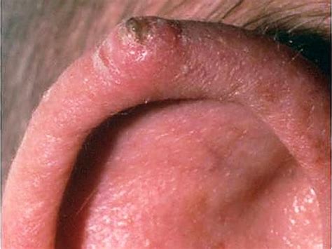 Basal Cell Carcinoma On The Nose Skin Cancer Or Mole How To Tell