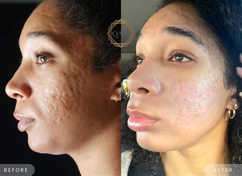 Acne Scars Treatment Newport Beach Qazi Cosmetic Center