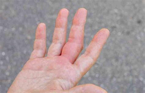 Arthritis In Fingers Causes Symptoms And Prevention