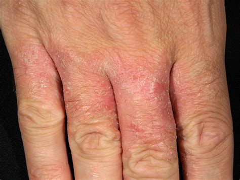 Irritant Contact Dermatitis Pictures Photos