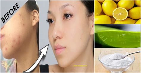How To Remove Pimple Marks 5 Natural Home Remedies Maxdio