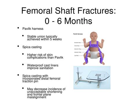 Ppt Femoral Shaft Fractures In Children Powerpoint Presentation Free