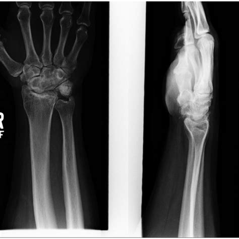 Post Operative Lateral And Pa Radiographs Of The Right Wrist