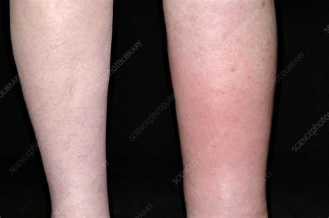 Cellulitis And Lymphoedema Of The Leg Stock Image C0042394