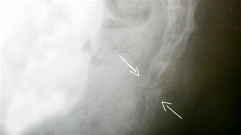 Fracture Coccyx Ostéopathe Le Thor