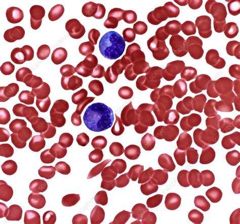 Anaemia Light Micrograph Stock Image C0374531 Science Photo Library