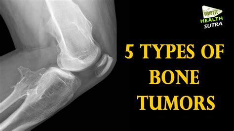 5 Types Of Bone Tumors Health Sutra Youtube