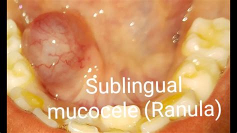 Sublingual Mucocele Ranula Surgically Removed By Laser Youtube