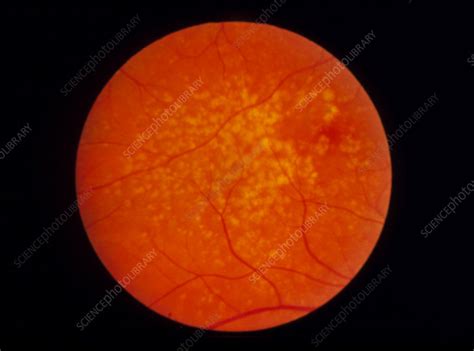 Ophthalmoscopy Of Retina Showing Drusen Stock Image M1550311