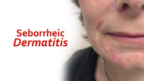 Seborrheic Dermatitis Causes Symptoms And Treatment Youtube