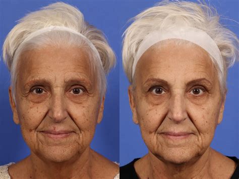 Botox Before And After Photos Philadelphia