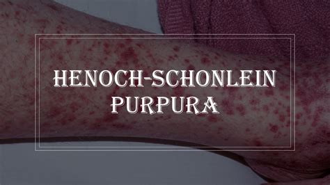 Henoch Schonlein Purpura Purple Rash On Skin Vasculitis Youtube