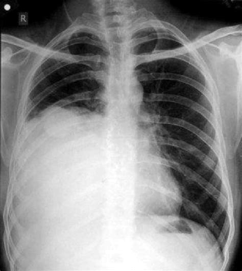 X­ray Of Chest Showing Homogenous Opacity In Right Mid And Lower Zones