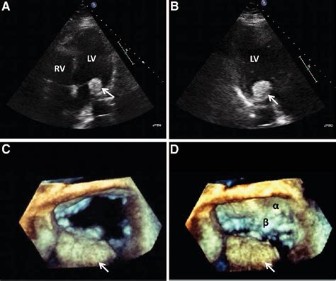 Figure 1 From Multimodality Cardiac Imaging In The Evaluation Of Mitral
